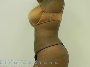 americanlipocenters_44.jpg